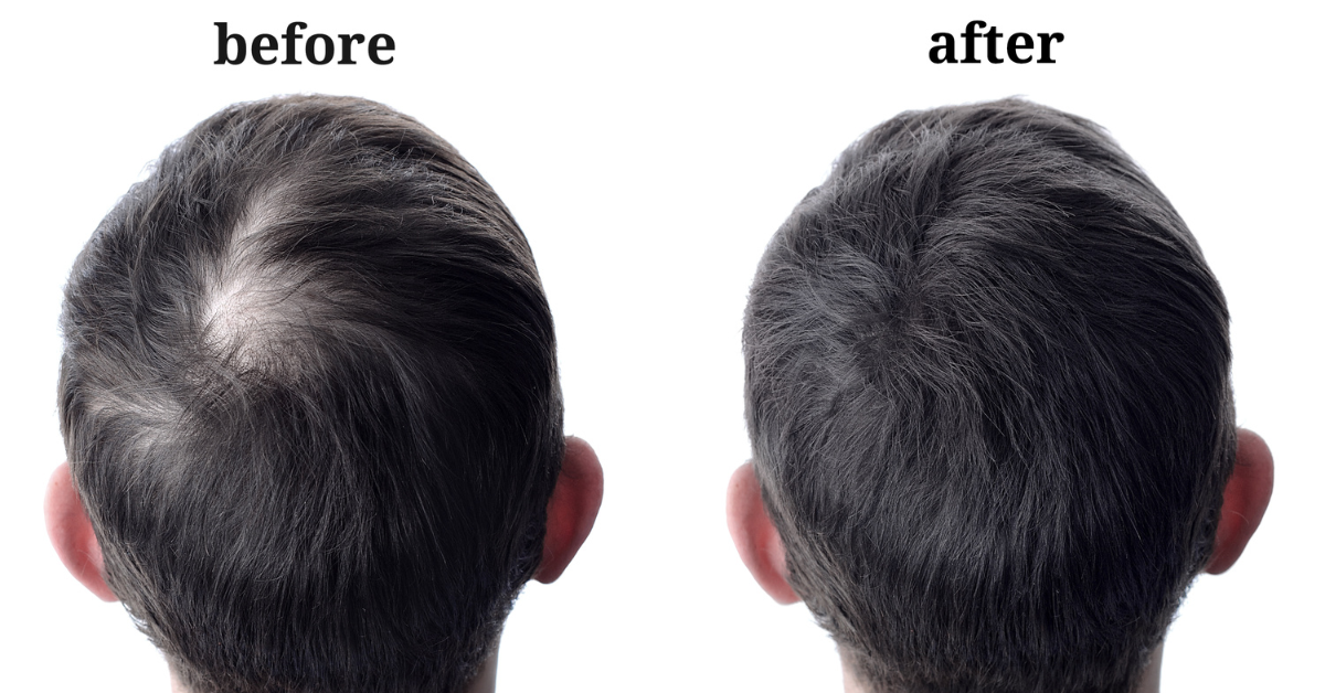 biotin for hair growth