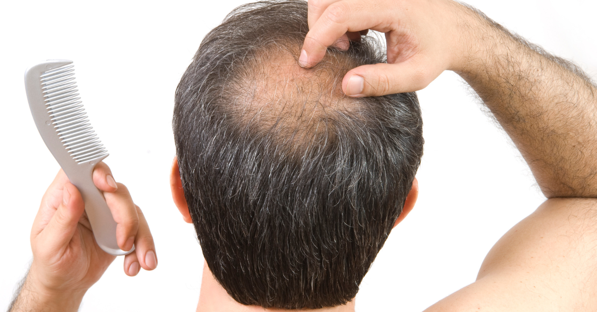 How To Prevent Balding: A Comprehensive Guide to Maintaining Healthy Hair
