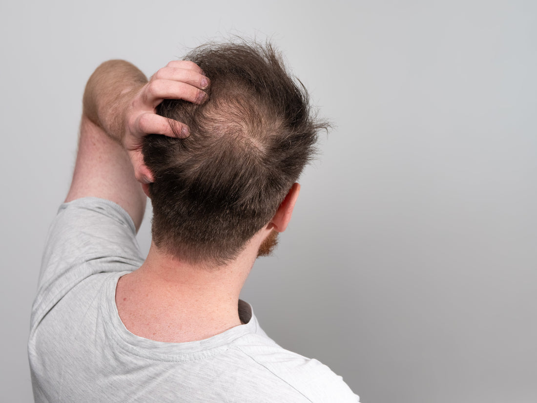 What Are DHT Blockers — And Why They’re Essential for Fighting Hair Loss