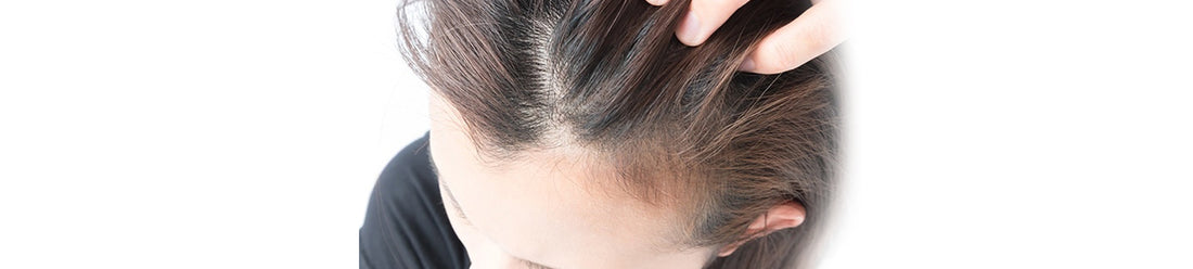Telogen Effluvium – Everything You Need To Know