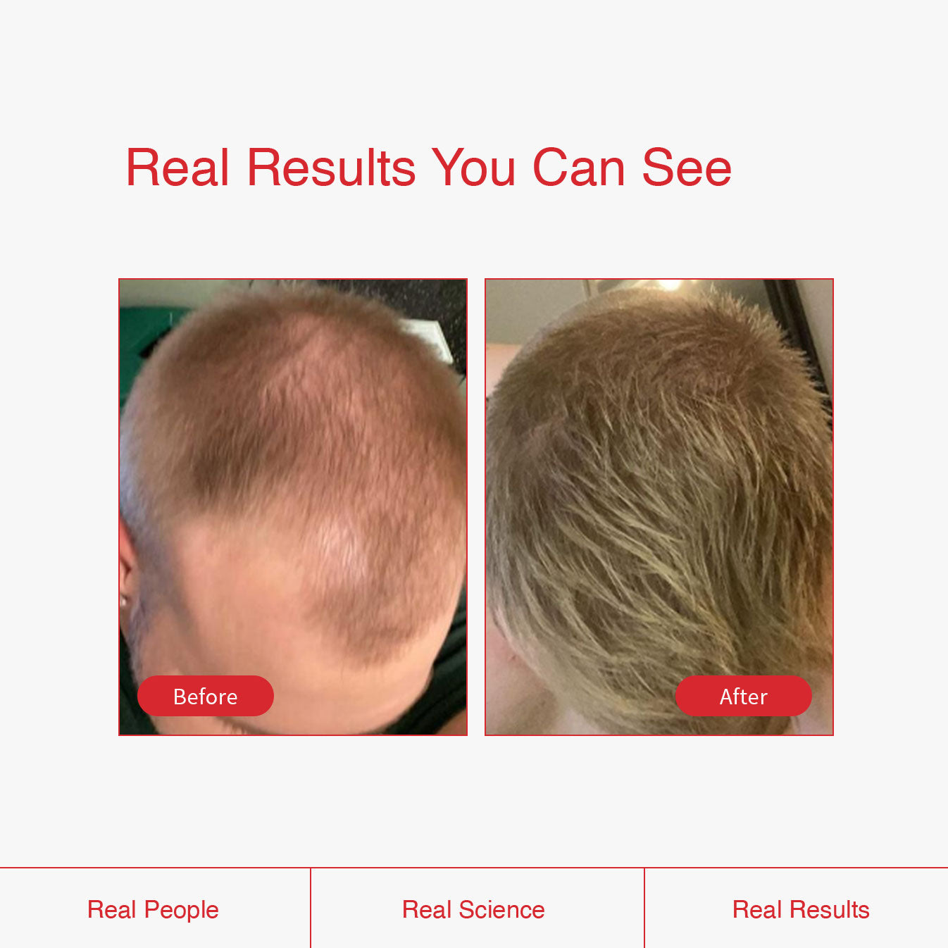 Minoxidil - Men's Topical Hair Regrowth Treatment